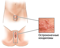 Остроконечные кондиломы